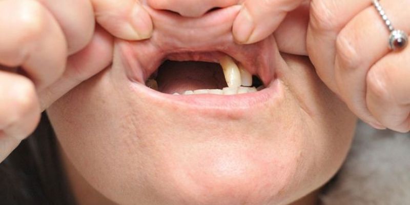 Chiêm bao thấy hàm trên rụng răng